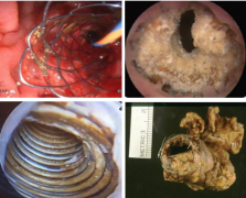 放进去的输尿管支架,还能轻松取出来吗?